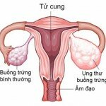 Triệu chứng và điều trị khối u buồng trứng ác tính
