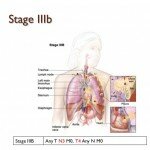 Ung thư phổi giai đoạn IIIB thì có nặng không?